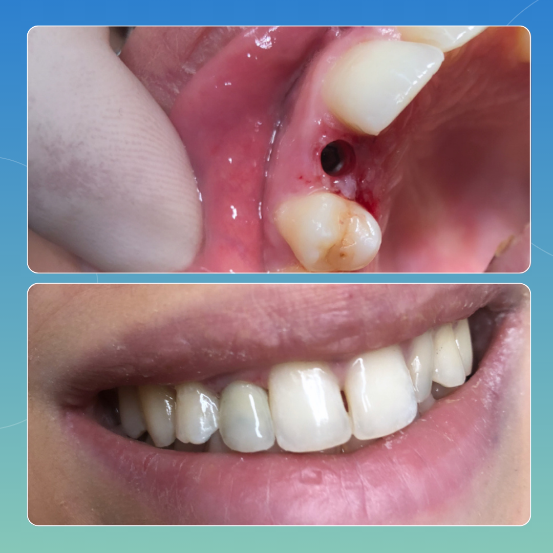 Impianto a carico immediato