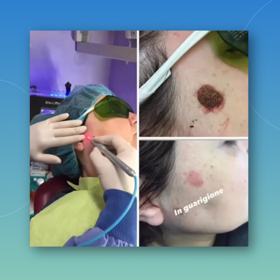 Chetatosi Seborroica