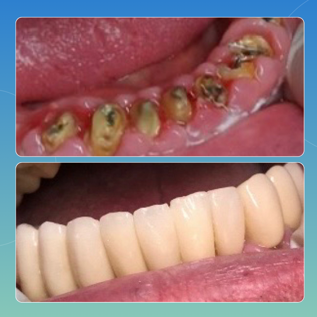 Impianti Superiori ed inferiori