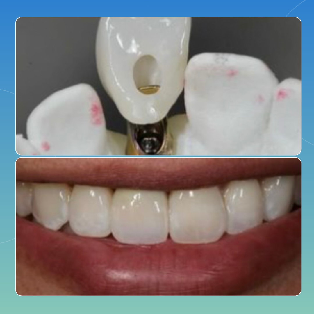 Corona Singola su Impianto