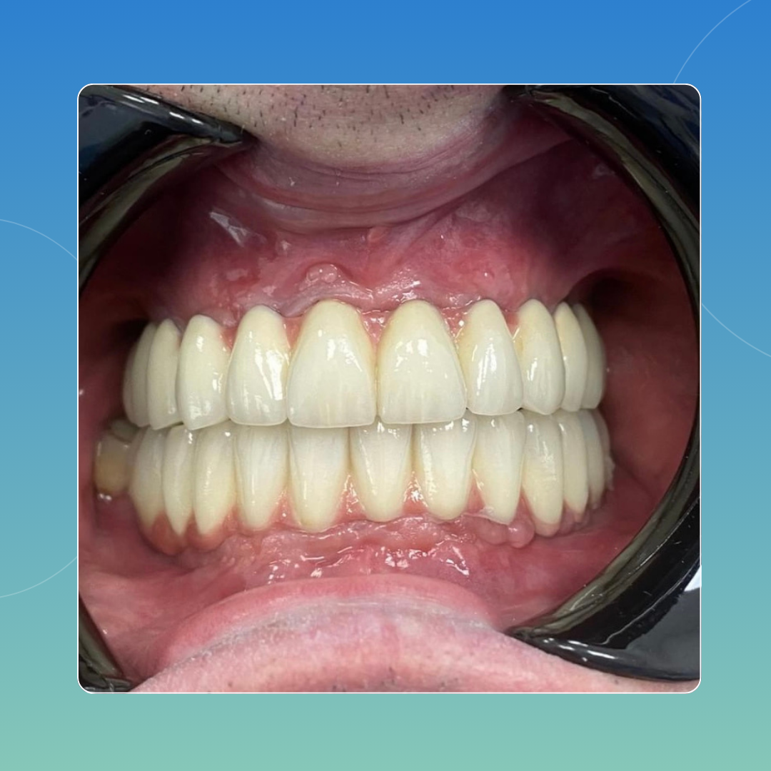 All on 6 Superiore e Inferiore