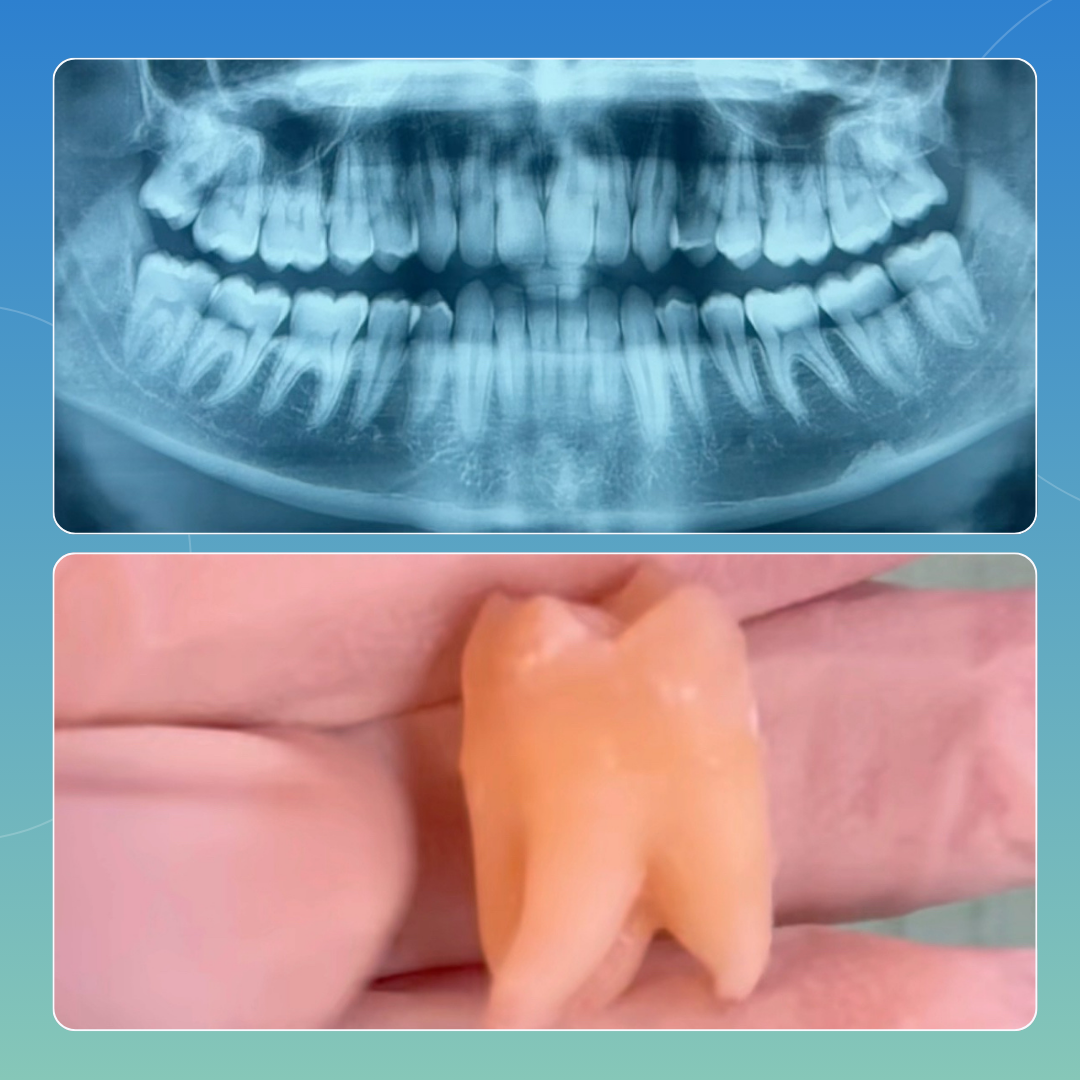 Estrazione dente del giudizio